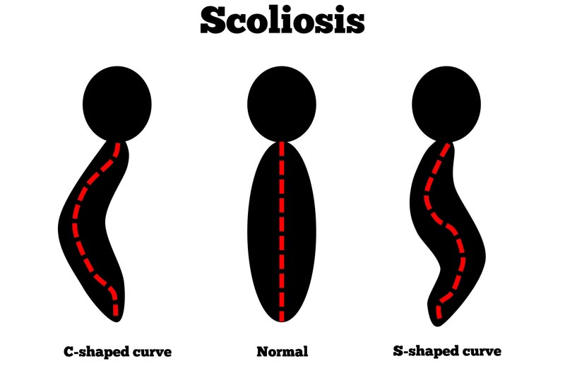 Olympia, Wa scoliosis treatment